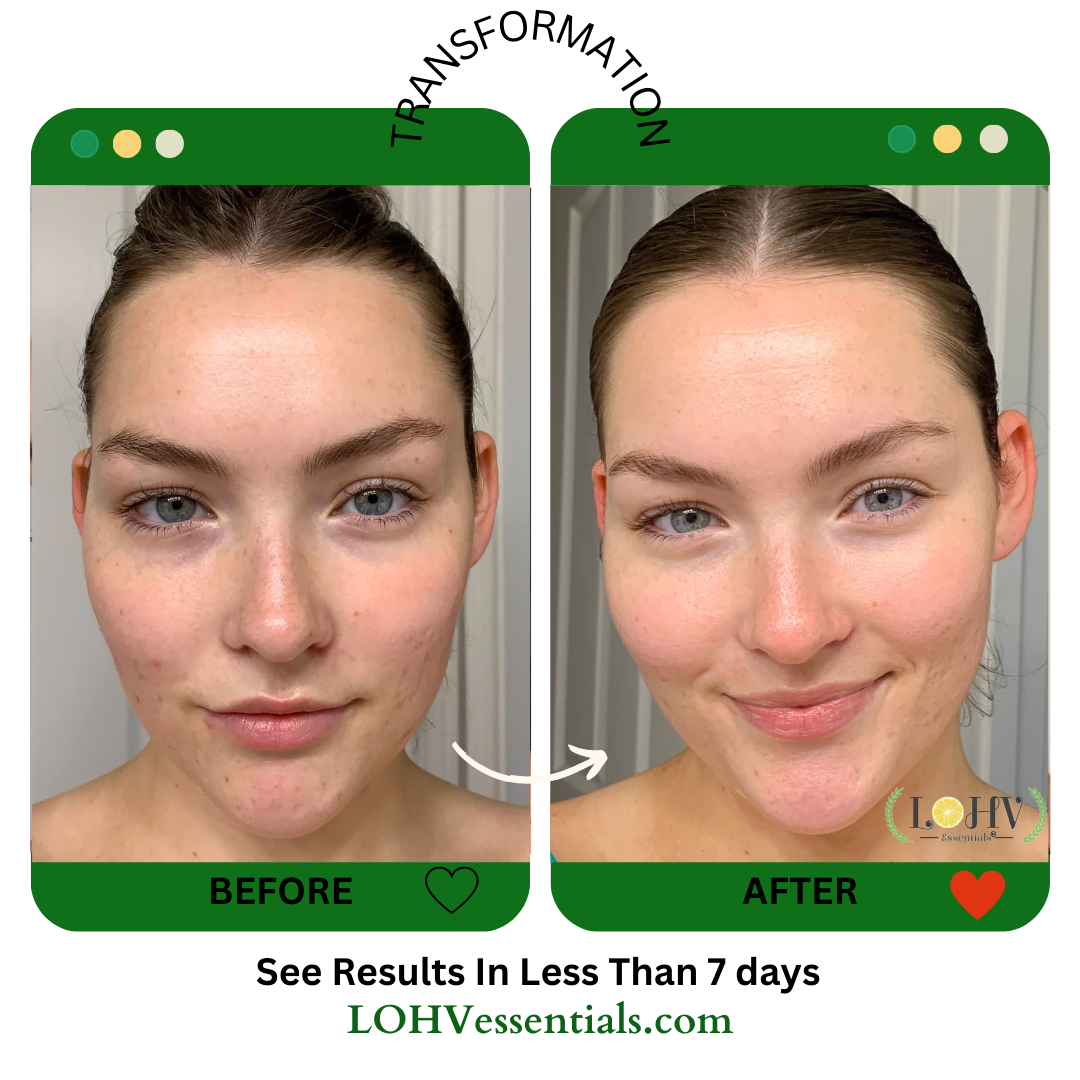 PREMIUM 100% VEGAN HYPER HYDRATOR Face Moisturizer With SPF 30 + Hyaluronic Acid + Lactic acid + Vitamin C + Kombucha